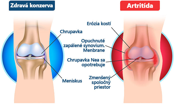 🍀🍀ArthroFree™ Krém proti bolesti kostí s obsahom včelieho jedu🐝(Najmä pre starších dospelých a odporúčané AAOS) x