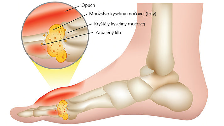 🍀🍀ArthroFree™ Krém proti bolesti kostí s obsahom včelieho jedu🐝(Najmä pre starších dospelých a odporúčané AAOS) x