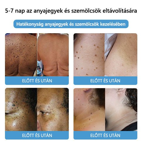 🐝🐝🐝[👑Hivatalos zászlóshajó üzlet👑] Lenaro™ Méhméreg vakond és szemölcs kezelési krém(👨‍⚕AAD AJÁNLJA)