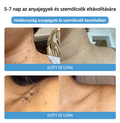 🐝🐝🐝[👑Hivatalos zászlóshajó üzlet👑] Lenaro™ Méhméreg vakond és szemölcs kezelési krém(👨‍⚕AAD AJÁNLJA)