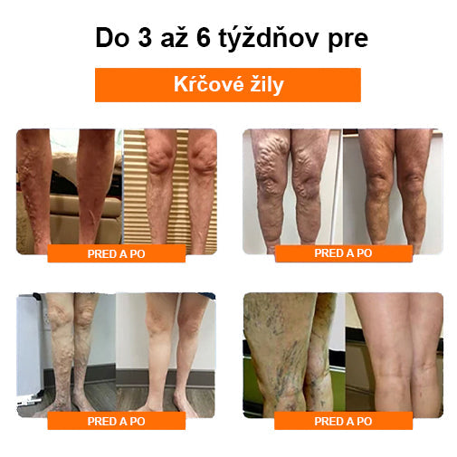 Eiceh® Rádiofrekvencia Bylinná tepelná podpora kolena (Odborné poradenstvo AAOS - pre všetky stavy súvisiace s chodidlami) x💖💖