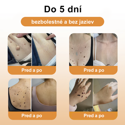 🎉🎉[✨Oficiálny Obchod Značky✨] 𝐙𝐨𝐞𝐧𝐜𝐠𝐳™ Krém na liečbu bradavíc a krtkov so včelím jedom (👨‍⚕𝐀𝐀𝐃 ODPORÚČAME)