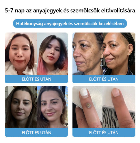 🐝🐝🐝[👑Hivatalos zászlóshajó üzlet👑] Lenaro™ Méhméreg vakond és szemölcs kezelési krém(👨‍⚕AAD AJÁNLJA)