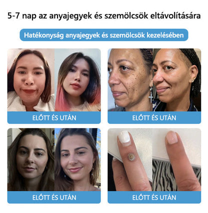 🐝🐝🐝[👑Hivatalos zászlóshajó üzlet👑] Lenaro™ Méhméreg vakond és szemölcs kezelési krém(👨‍⚕AAD AJÁNLJA)